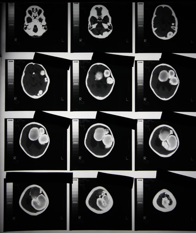 CT SCAN PNS  AXIAL (CONTRAST)