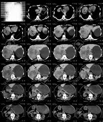 CT SCAN KUB WITH PROSTATE  (PLAIN)