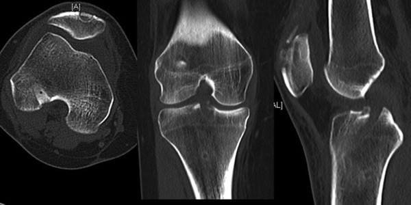 CT SCAN BOTH KNEE (PLAIN)