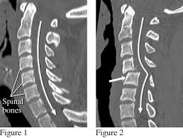 CT SCAN CERVICAL SPINE (CONTRAST)