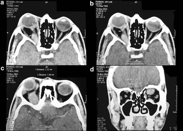 CT SCAN ORBIT (CONTRAST)