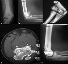 CT SCAN ELBOW (PLAIN)