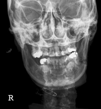 CT SCAN MANDIBLE CORONAL (PLAIN)