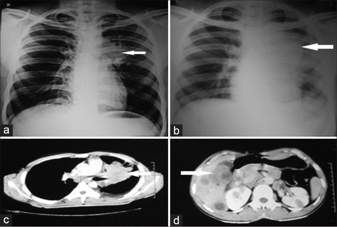 CT SCAN CHEST PLAIN