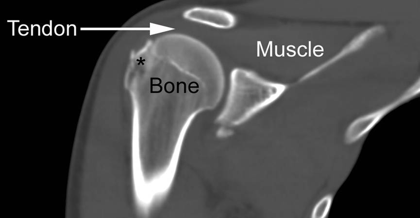 CT SCAN BOTH SHOULDER (CONTRAST)