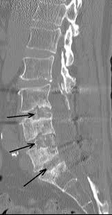 CT SCAN LUMBAR SPINE (CONTRAST)