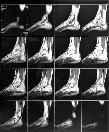 CT SCAN FOOT (CONTRAST)