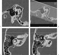 CT SCAN TEMPORAL BONE (EARS)