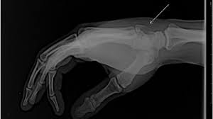 CT SCAN WRIST/HAND (CONTRAST)