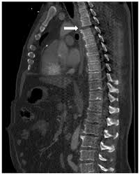 CT SCAN DORSAL SPINE (PLAIN)