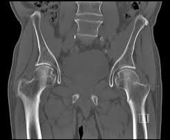 CT SCAN PELVIC/ HIP (CONTRAST)