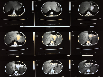 MRI KUB (CONTRAST)