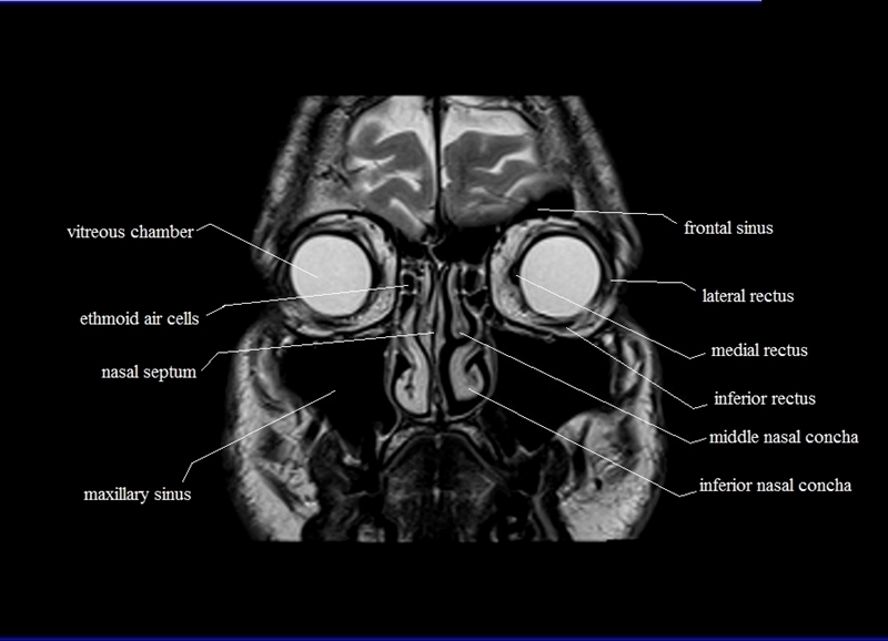 MRI PNS AXIAL (PLAIN) 