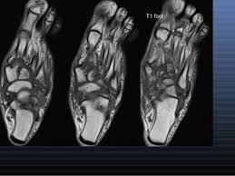 MRI BOTH FOOT (CONTRAST)