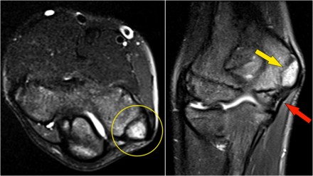 MRI BOTH ELBOW (CONTRAST)