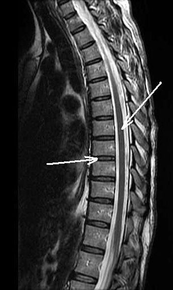 WHOLE SPINE MRI SCREENING