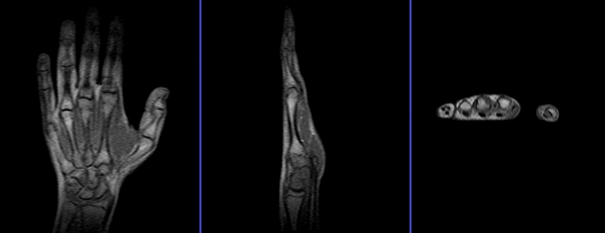 MRI HAND (CONTRAST)