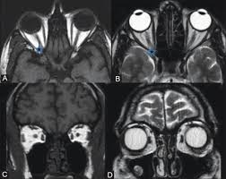 MRI ORBIT (CONTRAST)