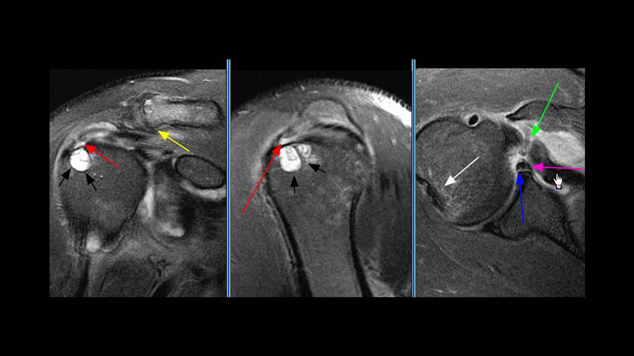 MRI SHOULDER (CONTRAST)