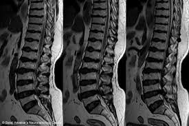 MRI LUMBAR SPINE (CONTRAST)