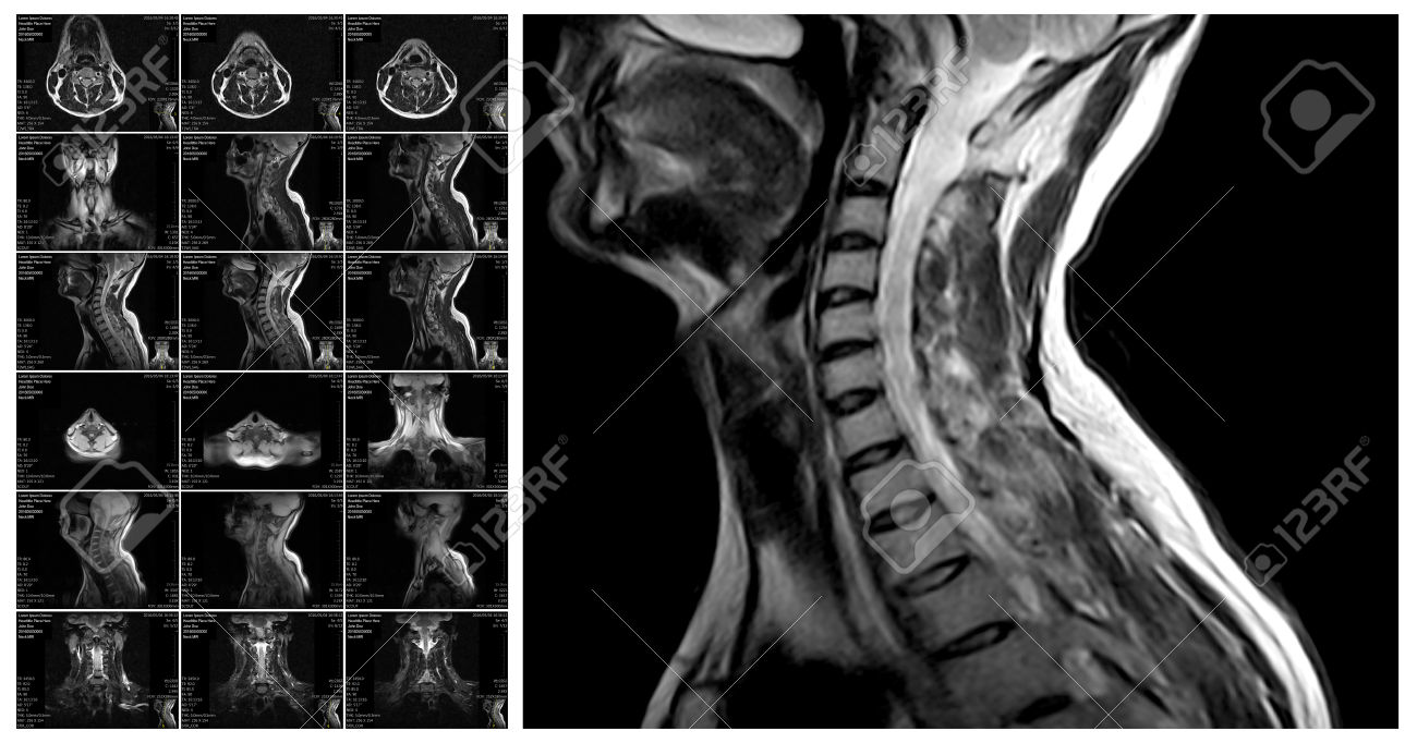 MRI CERVICAL SPINE (CONTRAST)