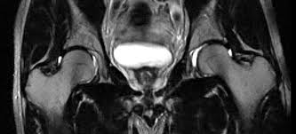 MRI PELVIC / HIP (PLAIN) 