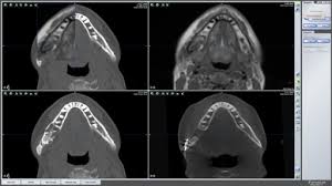 MRI MANDIBLE AXIAL & CORONAL (CONTRAST)