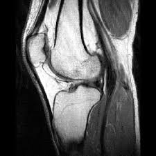 MRI BOTH KNEE (PLAIN)