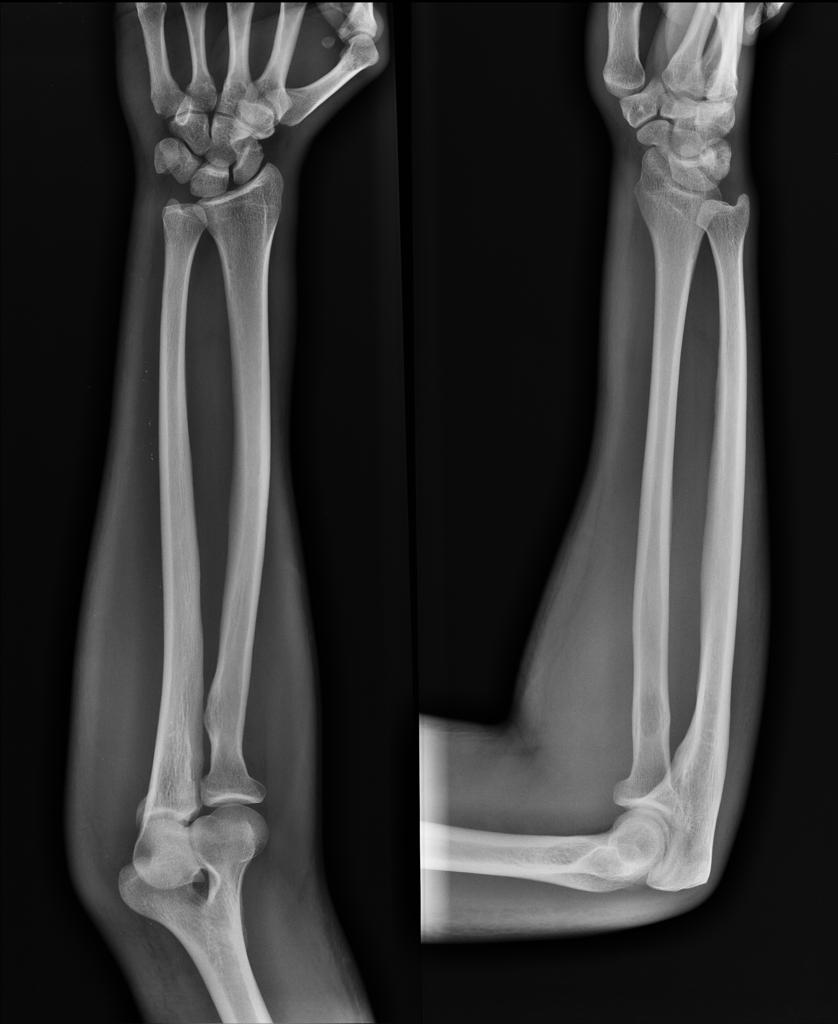 X-RAY AP/LATERAL VIEW FOREARM (ONE)