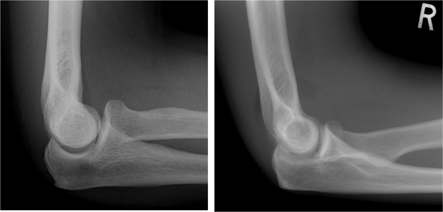 X-RAY LATERAL VIEW BOTH ELBOW