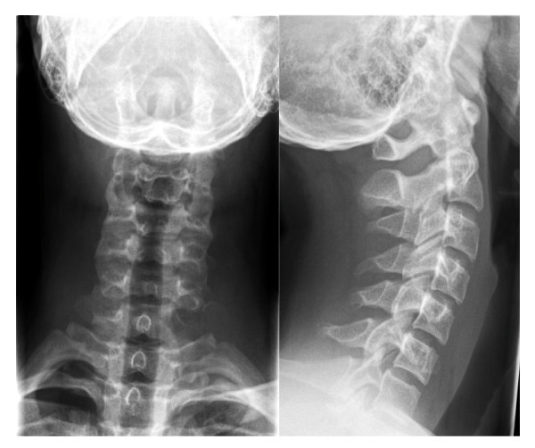 X-RAY AP/LATERAL VIEW CERVICAL SPINE