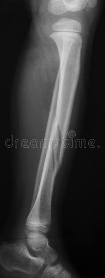 X-RAY LATERAL VIEW BOTH LEG