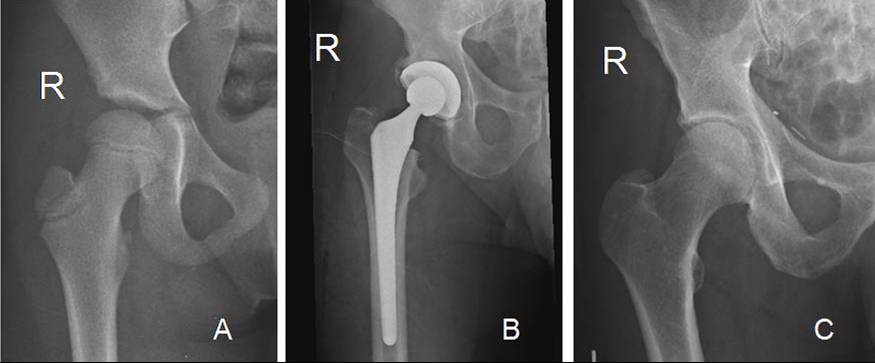 X-RAY AP/LATERAL VIEW BOTH HIP