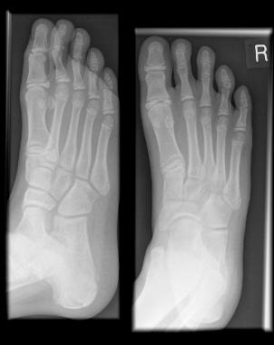 X-RAY AP VIEW BOTH FOOT