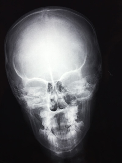 X-RAY AP VIEW SKULL/ HEAD