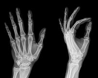 X-RAY AP/LATERAL VIEW HAND (ONE)