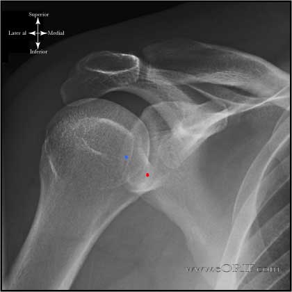 X-RAY AP VIEW SHOULDER