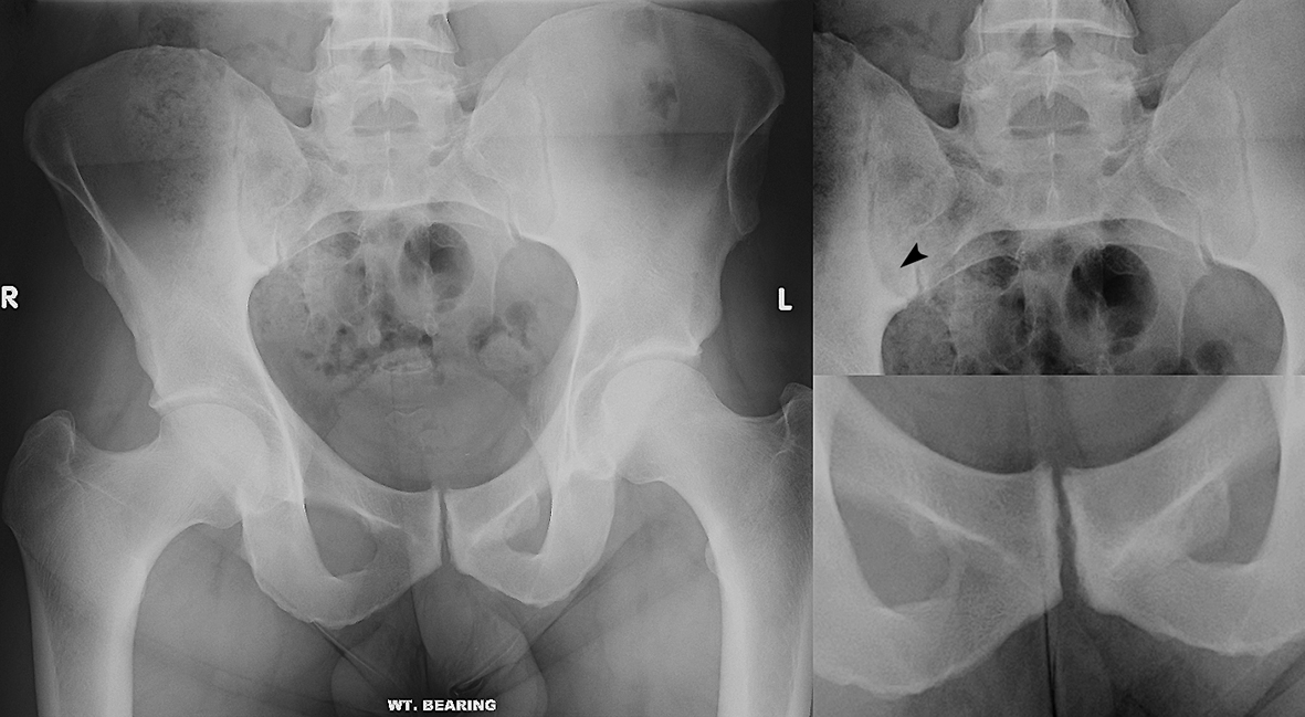 X-RAY AP/LATERAL VIEW PELVIC/ HIP (ONE)