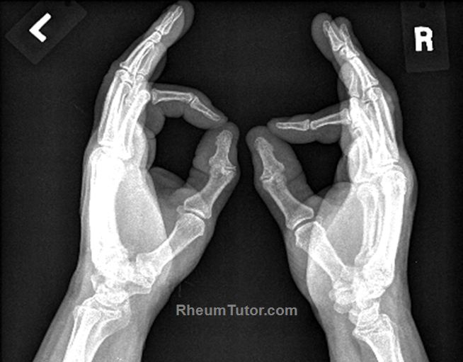 X-RAY LATERAL VIEW BOTH HAND