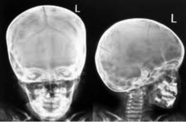 X-RAY AP/LATERAL VIEW  FACE 