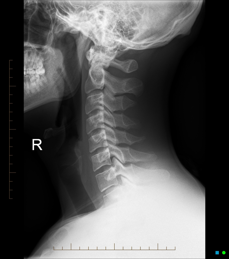 X-RAY LATERAL VIEW CERVICAL SPINE