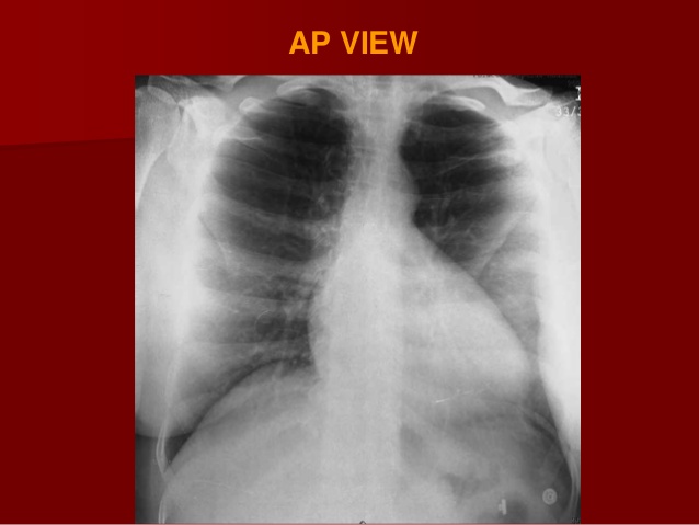 X-RAY AP VIEW CHEST