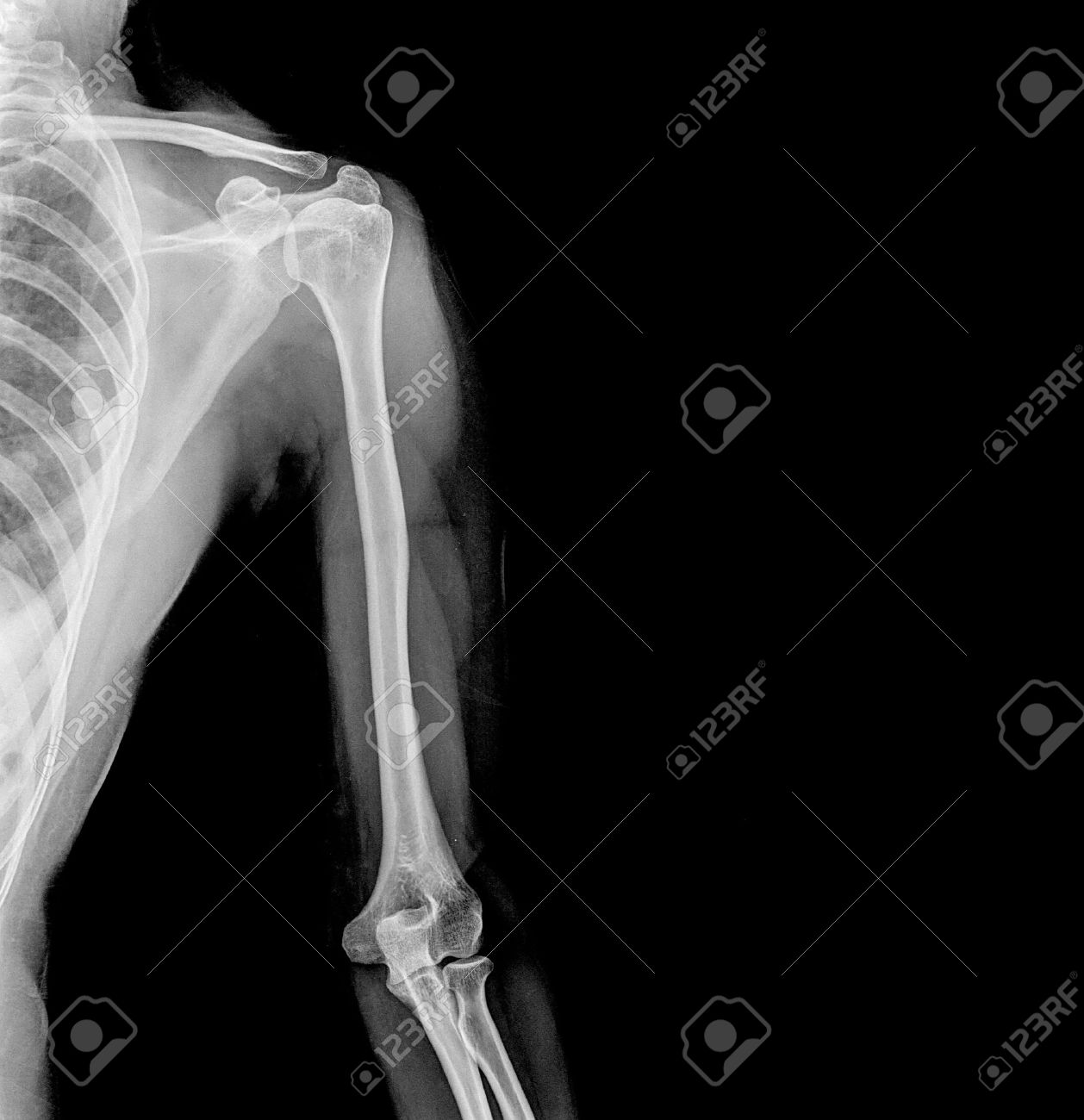 X-RAY AP VIEW BOTH ARM