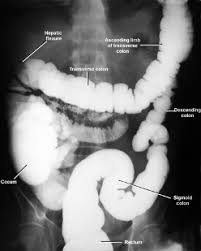 BARIUM ENEMA DOUBLE CONTRAST