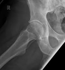 X-RAY LATERAL VIEW BOTH PELVIC/ HIP