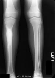 X-RAY AP/LATERAL VIEW LEG (ONE)