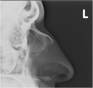 X-RAY NASAL BONE LATERAL VIEWS