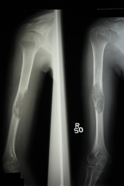 X-RAY AP/LATERAL VIEW BOTH ARM