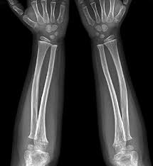 X-RAY AP VIEW BOTH FOREARM