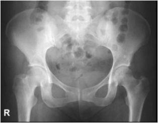 X-RAY AP VIEW PELVIC/ HIP